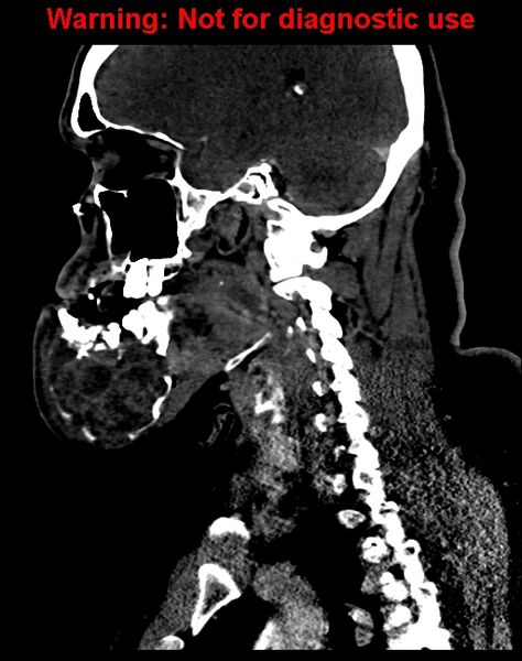File:Ameloblastoma (Radiopaedia 33126-34164 F 44).jpg