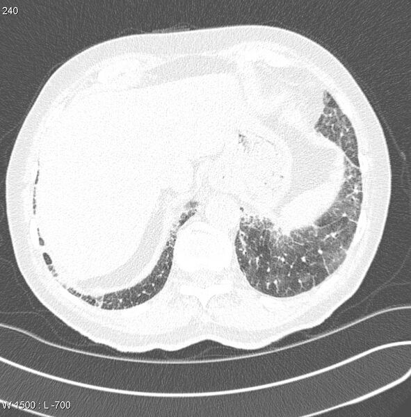 File:Amiodarone lung (Radiopaedia 6539-7851 Axial lung window 23).jpg