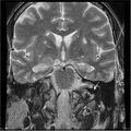 Amnestic syndrome secondary to hypoxic brain injury (Radiopaedia 24743-25004 F 10).jpg