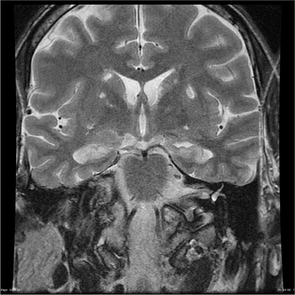 File:Amnestic syndrome secondary to hypoxic brain injury (Radiopaedia 24743-25004 F 10).jpg