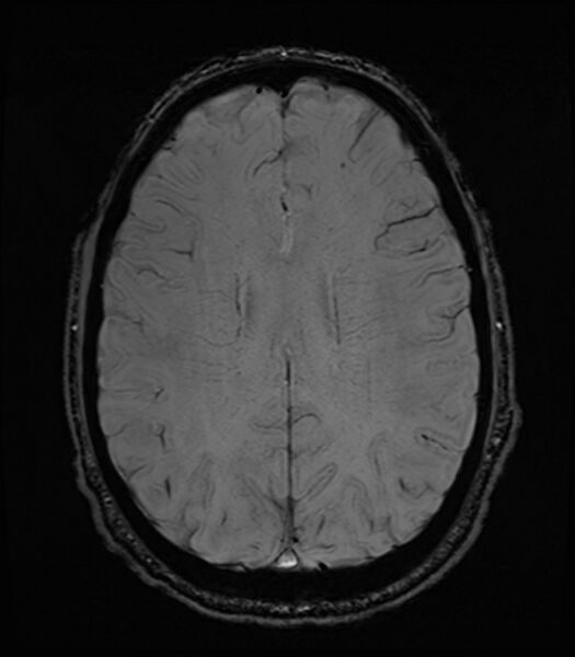 File:Amyotrophic lateral sclerosis (Radiopaedia 87352-103658 Axial SWI 41).jpg