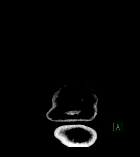 File:Anaplastic oligodendroglioma (Radiopaedia 79571-92753 Coronal non-contrast 74).jpg