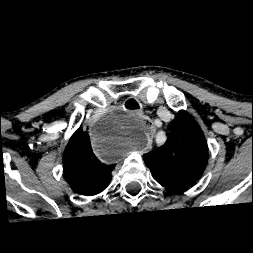 Anaplastic thyroid carcinoma (Radiopaedia 79087-92034 B 23).jpg