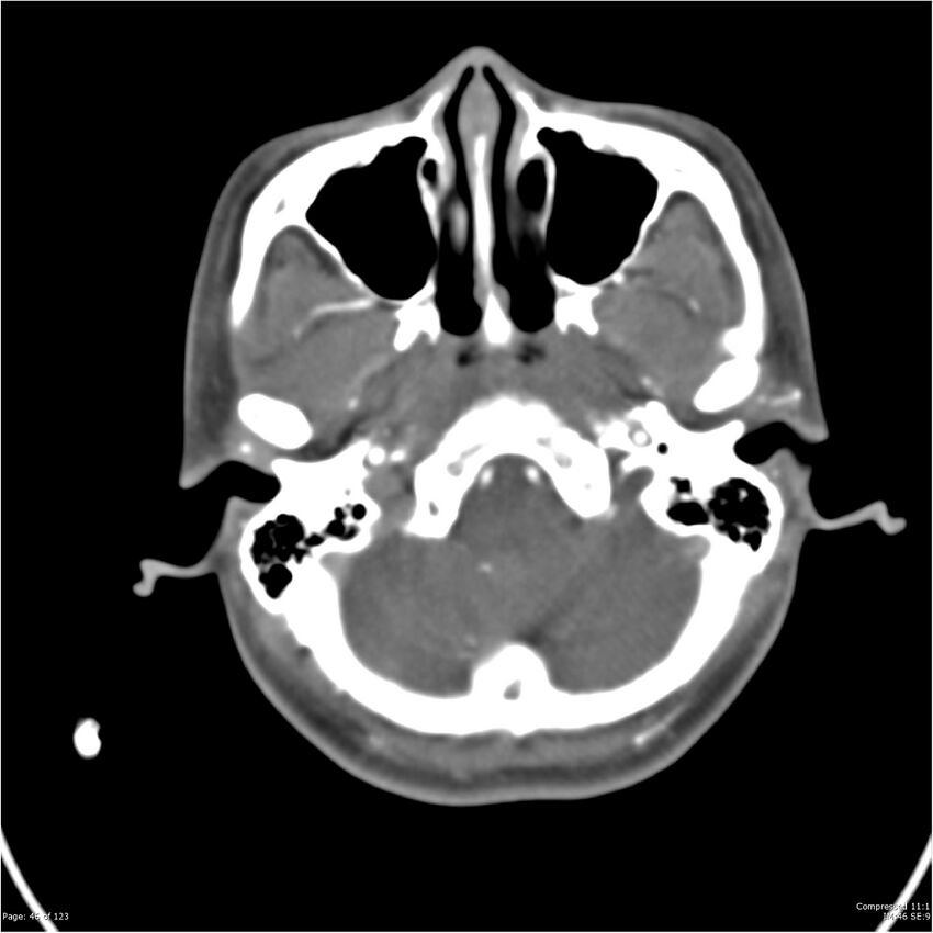 Aneurysmal subarachnoid hemorrhage and Moya Moya disease (Radiopaedia 34306-35593 Axial CT COW 46).jpg
