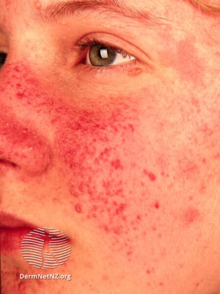 File:Angiofibromas in tuberous sclerosis (DermNet NZ systemic-angiofibromas-18).jpg