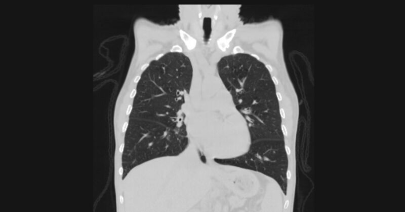 File:Angioinvasive aspergellosis (Radiopaedia 66995-76315 Coronal lung window 27).jpg