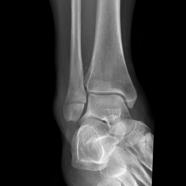 File:Ankle fracture - Weber A (Radiopaedia 7965-8811 Mortise 1).jpg