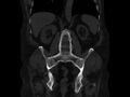 Ankylosing spondylitis (Radiopaedia 44609-48357 Coronal bone window 55).jpg