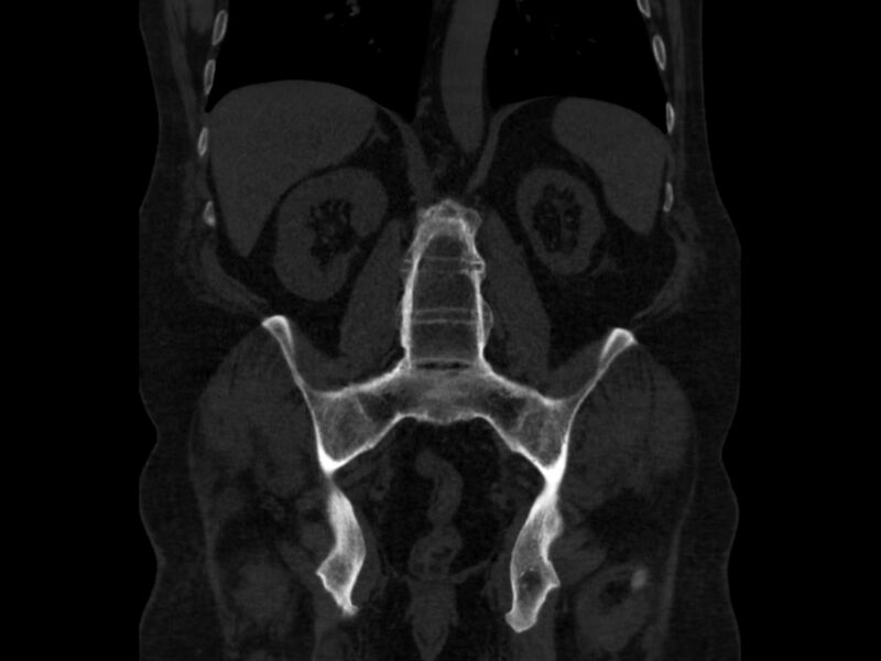 File:Ankylosing spondylitis (Radiopaedia 44609-48357 Coronal bone window 55).jpg