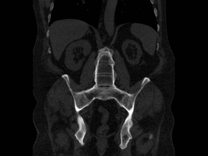 Ankylosing spondylitis (Radiopaedia 44609-48357 Coronal bone window 55).jpg