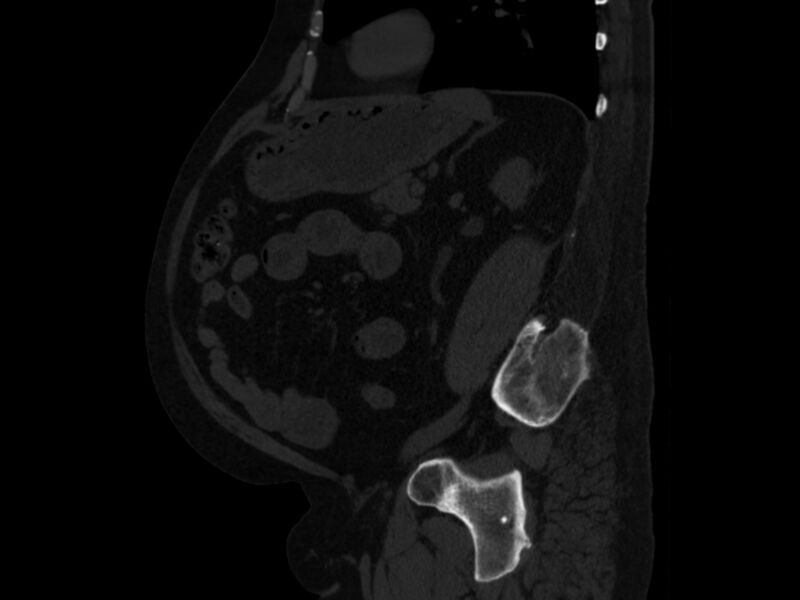 File:Ankylosing spondylitis (Radiopaedia 44609-48357 Sagittal bone window 74).jpg