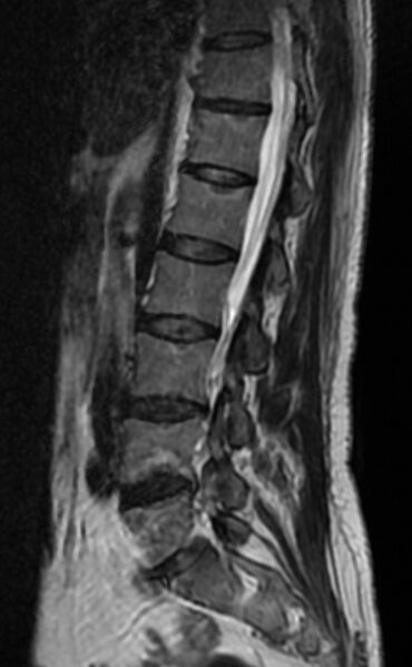 File:Ankylosing spondylitis - Andersson lesion (Radiopaedia 81878-95838 Sagittal T2 5).jpg