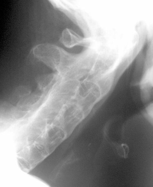 File:Ankylosing spondylitis - cervical spine (Radiopaedia 2912).jpg