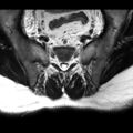 Ankylosing spondylitis with zygapophyseal arthritis (Radiopaedia 38433-40517 A 5).jpg