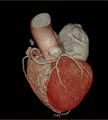 Anomalous left coronary artery- prepulmonic course (Radiopaedia 29253-29667 3D VRT 5).JPG