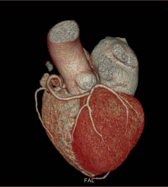 File:Anomalous left coronary artery- prepulmonic course (Radiopaedia 29253-29667 3D VRT 5).JPG