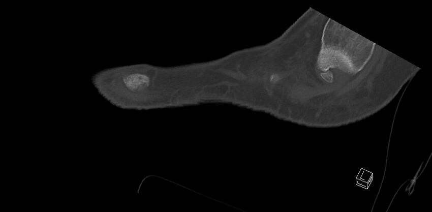 Anterior calcaneal process fracture (Radiopaedia 63353-71943 C 51).jpg