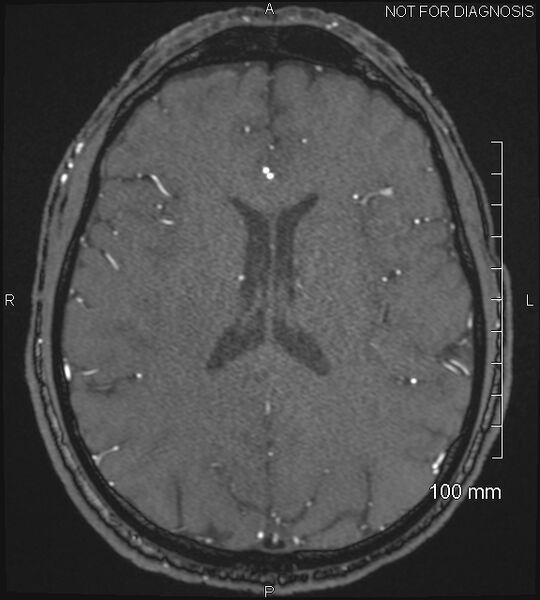 File:Anterior cerebral artery aneurysm (Radiopaedia 80683-94127 Axial MRA 152).jpg
