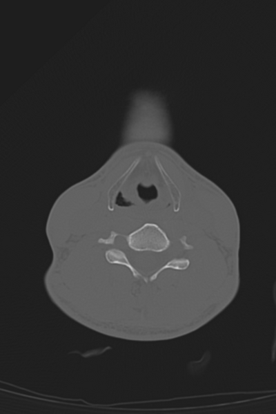File:Anterior nasal spine fracture (Radiopaedia 46138-50494 Axial bone window 84).png