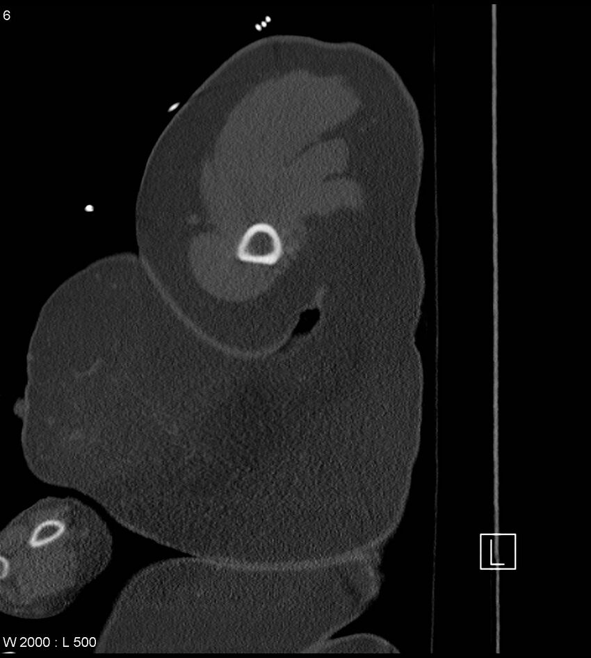 Anterior shoulder dislocation (CT) (Radiopaedia 59032-66309 Sagittal bone window 3).jpg