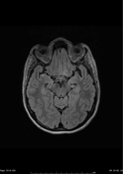 File:Anterior temporal lobe perivascular space (Radiopaedia 40946-43650 Axial FLAIR 15).jpg