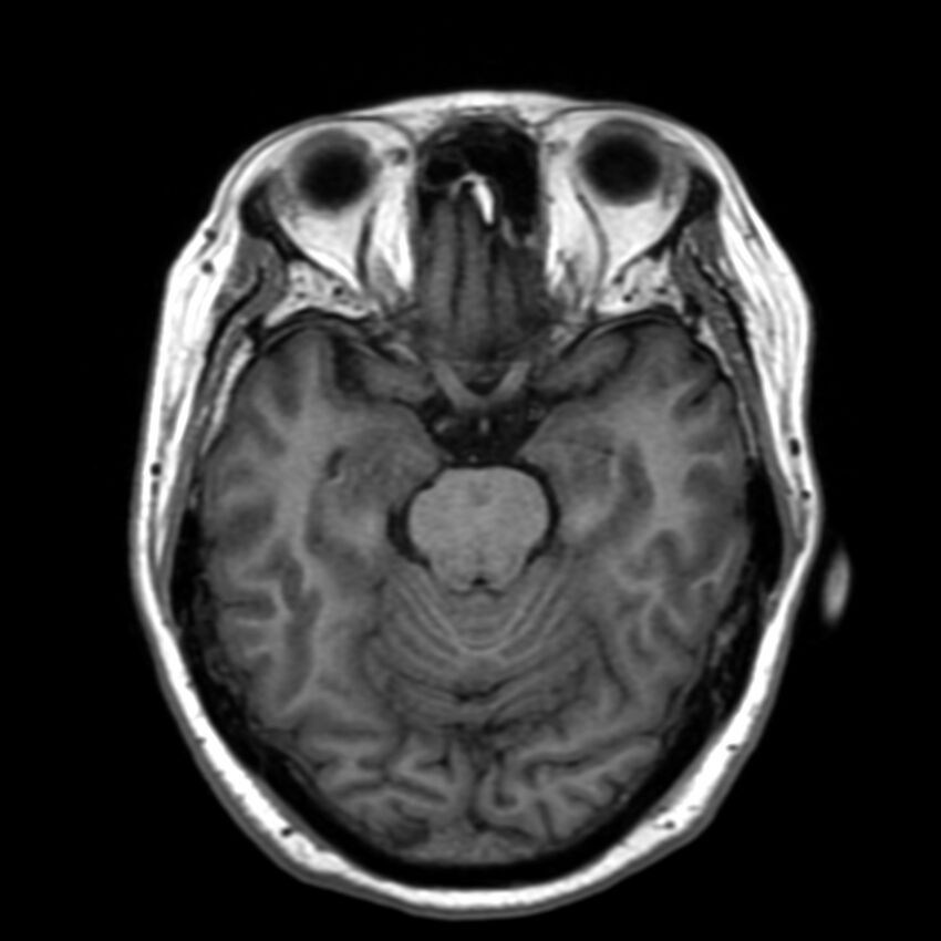 Anti-MOG encephalomyelitis (Radiopaedia 73831-84646 Axial T1 19).jpg