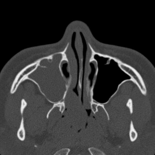 File:Antrochoanal polyp (Radiopaedia 33984-35202 Axial bone window 24).jpg