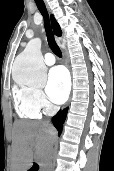 File:Aortic coarctation with aneurysm (Radiopaedia 74818-85828 B 79).jpg