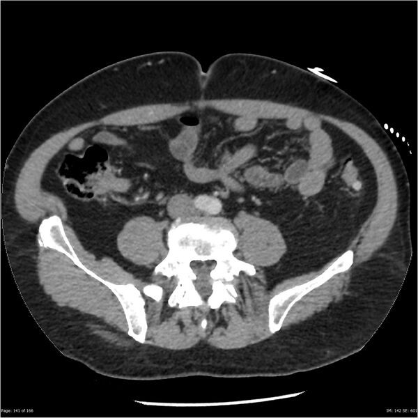 File:Aortic dissection- Stanford A (Radiopaedia 37759-39664 A 132).jpg