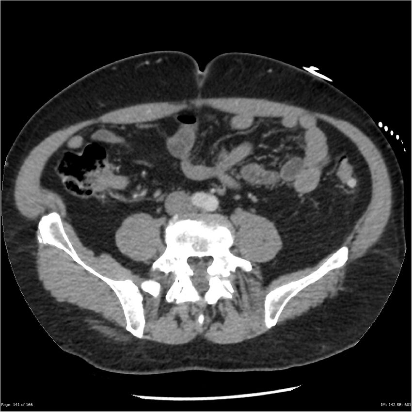 Aortic dissection- Stanford A (Radiopaedia 37759-39664 A 132).jpg