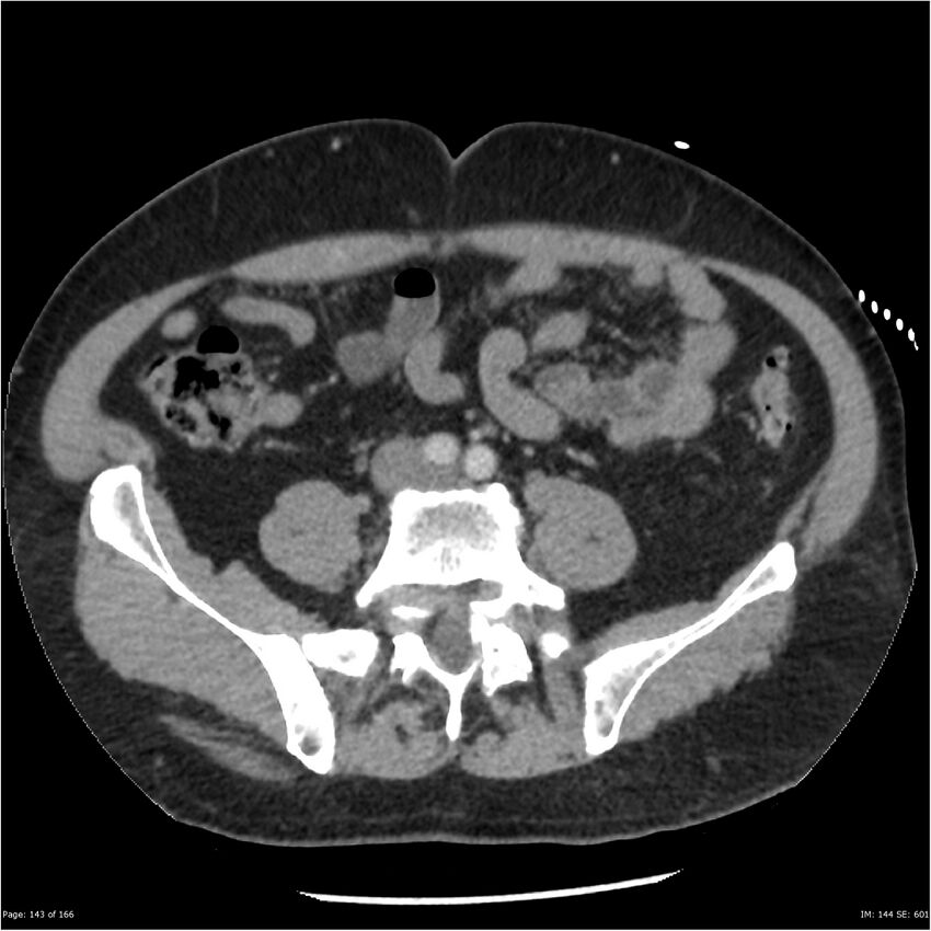 Aortic dissection- Stanford A (Radiopaedia 37759-39664 A 134).jpg