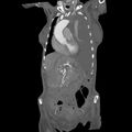 Aortic dissection (Radiopaedia 68763-78691 B 8).jpeg
