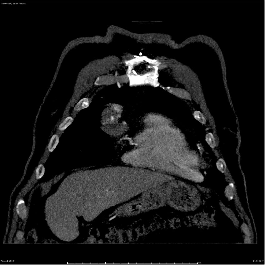 Aortic dissection - Stanford type A (Radiopaedia 26183-26315 A 2).jpg