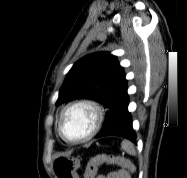 File:Aortic dissection - Stanford type A (Radiopaedia 29247-29659 C 1).jpg