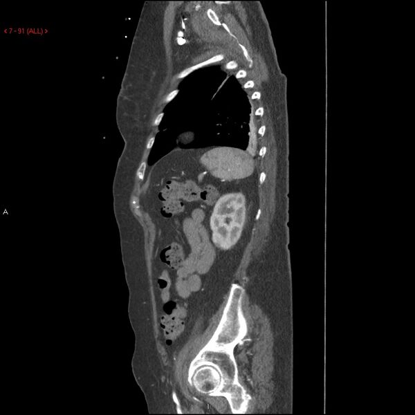 File:Aortic intramural hematoma (Radiopaedia 27746-28001 C 60).jpg