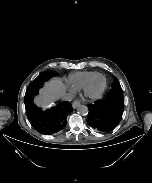 File:Aortoenteric fistula (Radiopaedia 84308-99603 Axial non-contrast 7).jpg