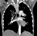 Aortopulmonary window, interrupted aortic arch and large PDA giving the descending aorta (Radiopaedia 35573-37074 D 43).jpg