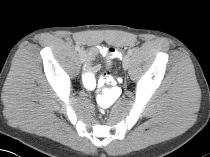 File:Appendicitis and incidental foregut duplication cyst (Radiopaedia 52962-58916 A 85).jpg