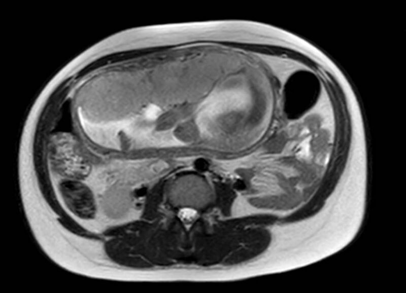 File:Appendicitis in gravida (MRI) (Radiopaedia 89433-106395 Axial T2 33).jpg