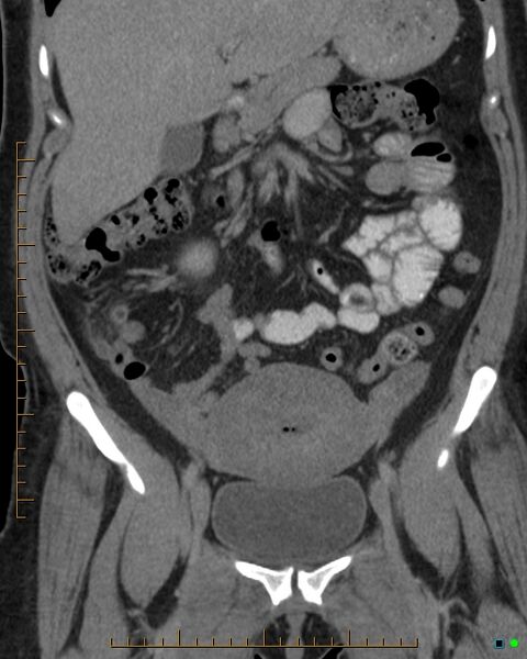 File:Appendicitis post recent cesarian section (Radiopaedia 29594-30102 D 7).jpg