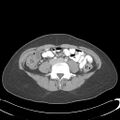 Appendicitis with minimal stranding but appendicolith (Radiopaedia 29035-29397 A 53).jpg