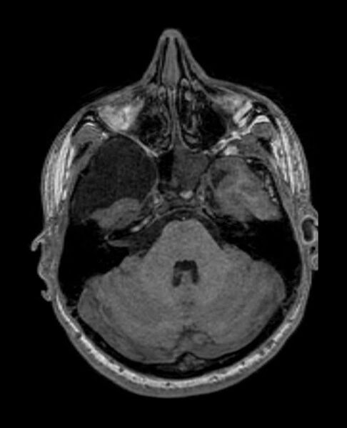 File:Arachnoid cyst- extremely large (Radiopaedia 68741-78451 Axial T1 21).jpg
