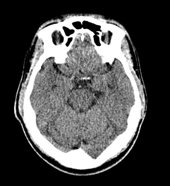 File:Arachnoid cyst of the ambient cistern (Radiopaedia 81301-94986 Axial non-contrast 25).jpg