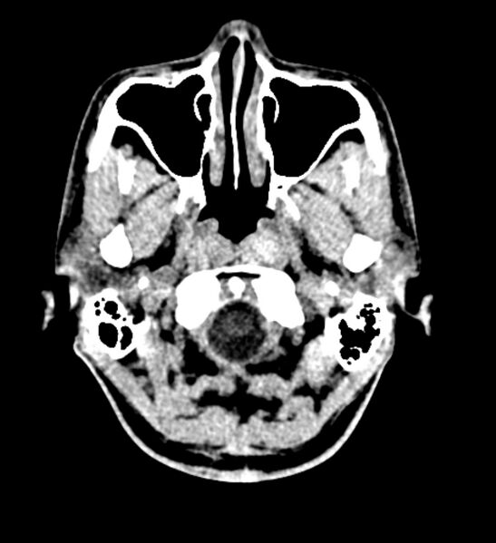 File:Arachnoid cyst of the ambient cistern (Radiopaedia 81301-94986 Axial non-contrast 3).jpg