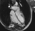 Arrhythmogenic right ventricular cardiomyopathy (Radiopaedia 39806-42237 D 38).jpg