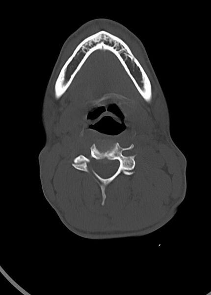 File:Arrow injury to the head (Radiopaedia 75266-86388 Axial bone window 15).jpg