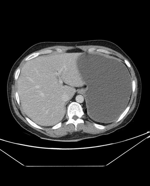 File:Arterial occlusive mesenteric ischemia (Radiopaedia 84641-100054 A 21).jpg