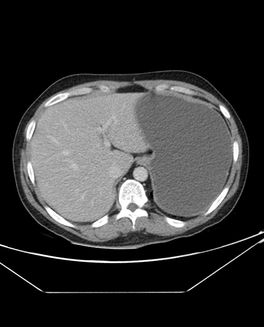 Arterial occlusive mesenteric ischemia (Radiopaedia 84641-100054 A 21).jpg