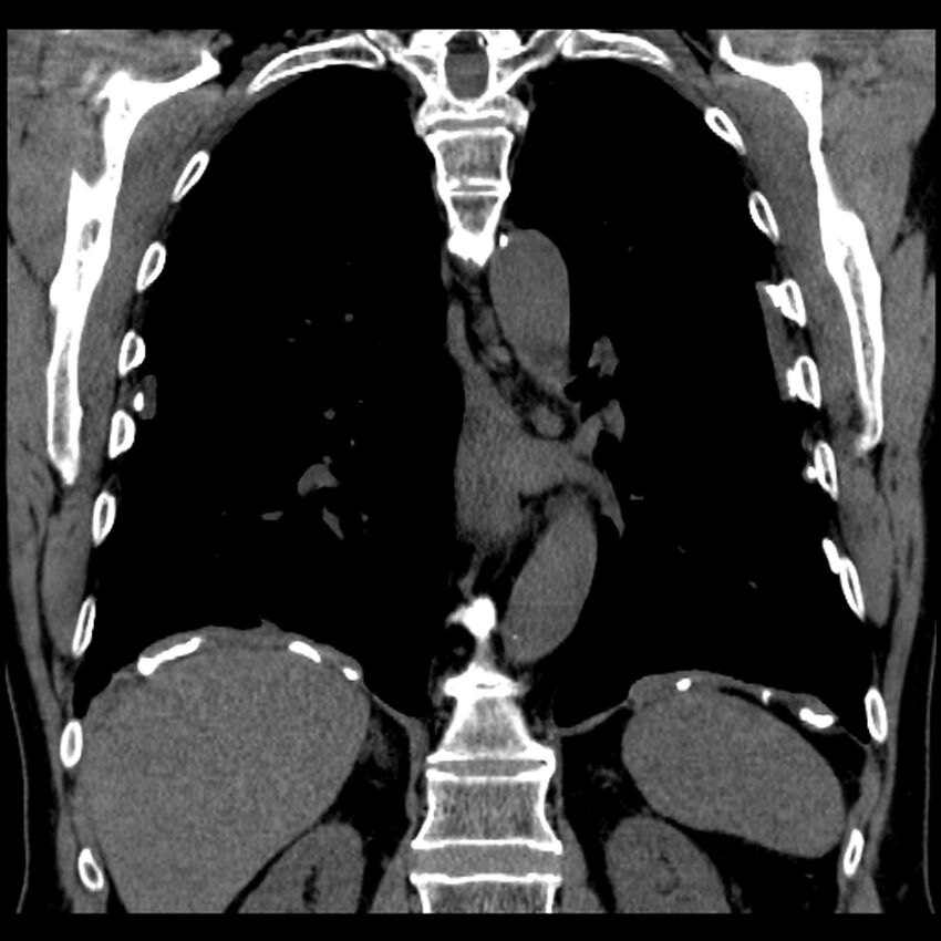 Asbestos-related pleural plaques (Radiopaedia 39069-41255 Coronal non-contrast 30).jpg