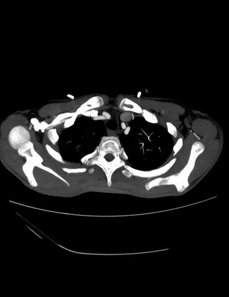 File:Ascending aortic pseudoaneurysm (Radiopaedia 28638-28910 A 2).jpg